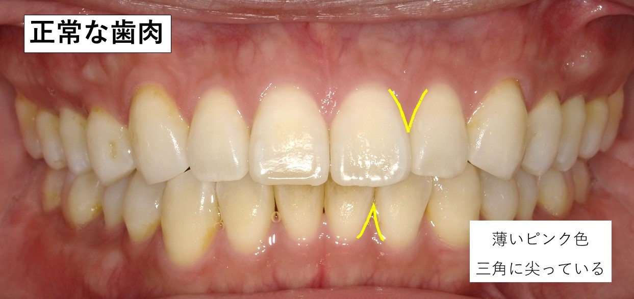 正常な歯肉 三角