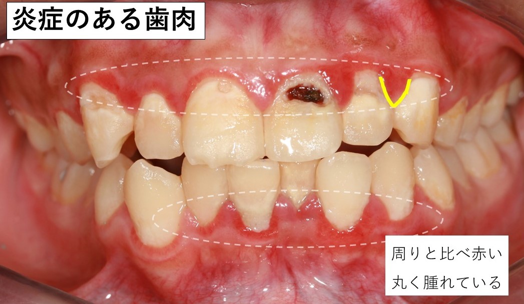 歯肉炎になっている歯肉 腫れ